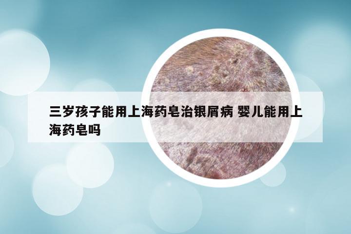 三岁孩子能用上海药皂治银屑病 婴儿能用上海药皂吗