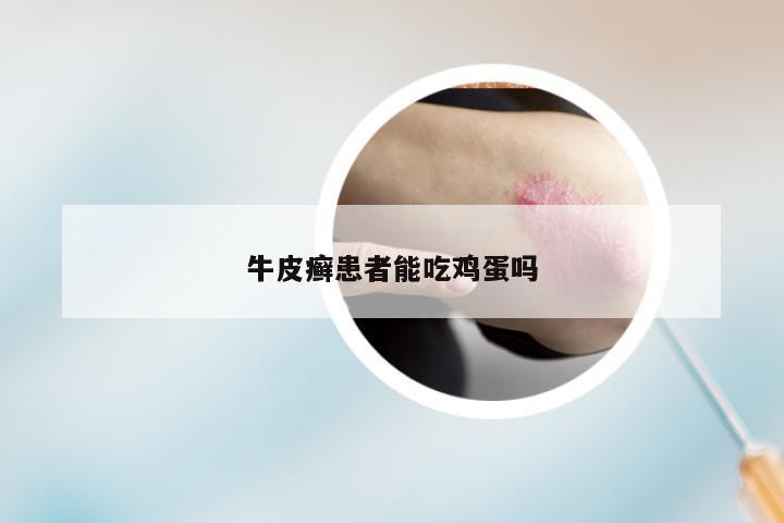 牛皮癣患者能吃鸡蛋吗