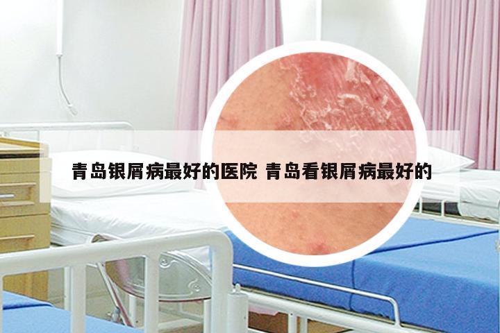 青岛银屑病最好的医院 青岛看银屑病最好的
