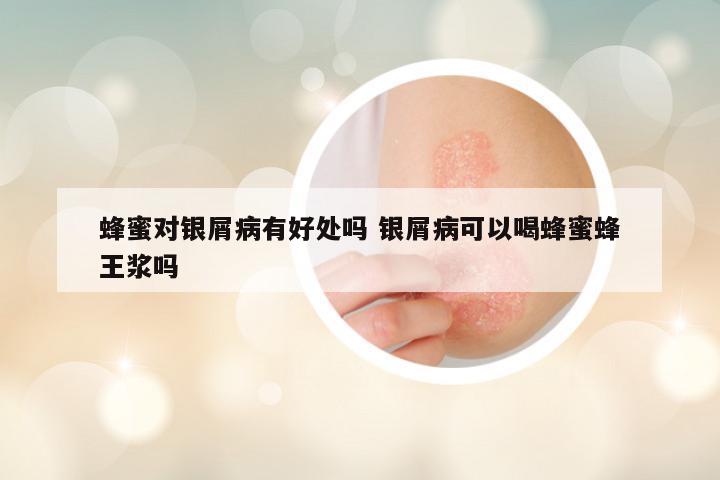 蜂蜜对银屑病有好处吗 银屑病可以喝蜂蜜蜂王浆吗