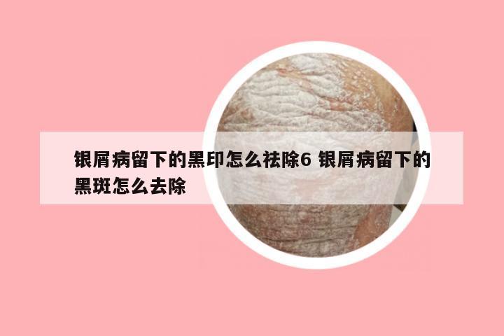 银屑病留下的黑印怎么祛除6 银屑病留下的黑斑怎么去除