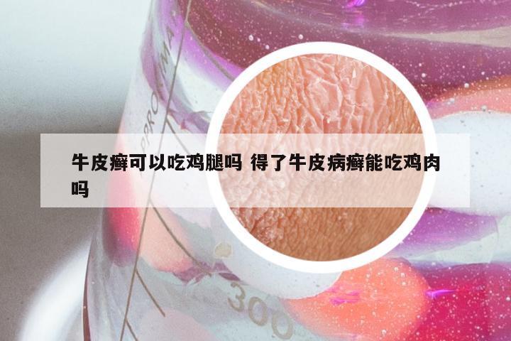 牛皮癣可以吃鸡腿吗 得了牛皮病癣能吃鸡肉吗