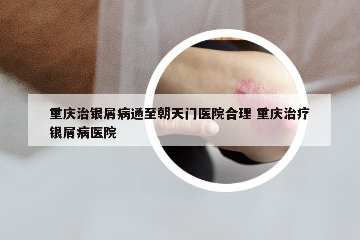 重庆治银屑病通至朝天门医院合理 重庆治疗银屑病医院