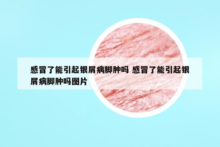 感冒了能引起银屑病脚肿吗 感冒了能引起银屑病脚肿吗图片