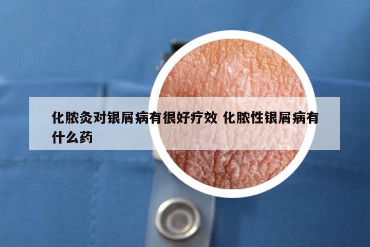 化脓灸对银屑病有很好疗效 化脓性银屑病有什么药