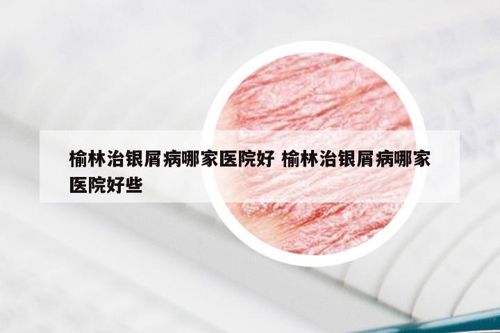 榆林治银屑病哪家医院好 榆林治银屑病哪家医院好些