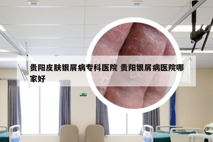 贵阳皮肤银屑病专科医院 贵阳银屑病医院哪家好