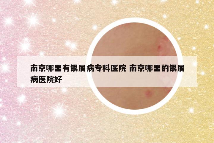 南京哪里有银屑病专科医院 南京哪里的银屑病医院好