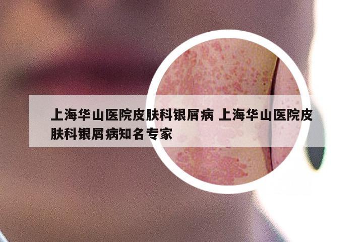 上海华山医院皮肤科银屑病 上海华山医院皮肤科银屑病知名专家