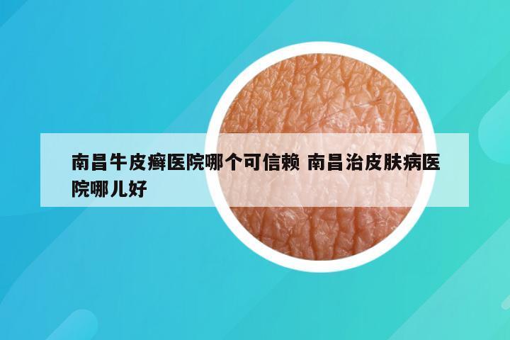 南昌牛皮癣医院哪个可信赖 南昌治皮肤病医院哪儿好