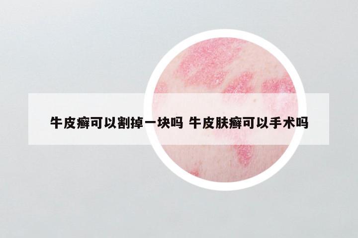 牛皮癣可以割掉一块吗 牛皮肤癣可以手术吗