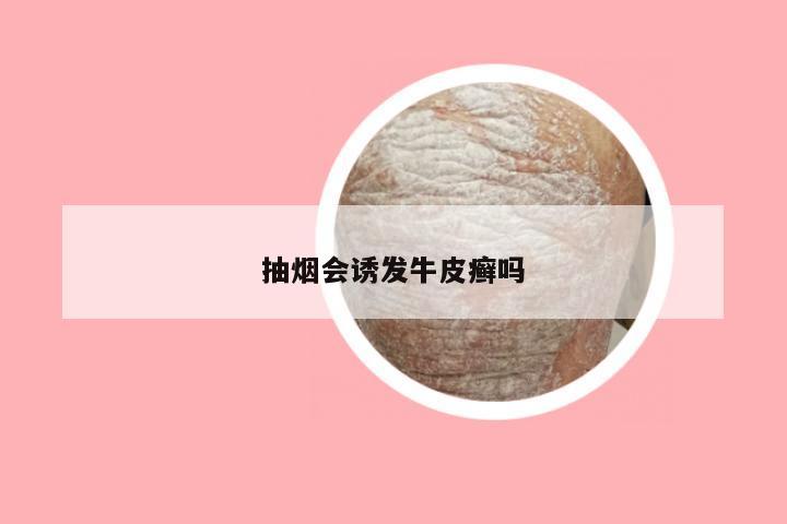 抽烟会诱发牛皮癣吗
