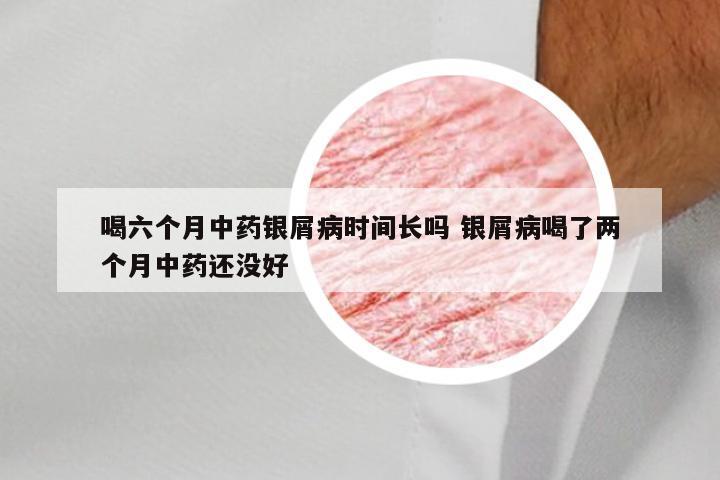 喝六个月中药银屑病时间长吗 银屑病喝了两个月中药还没好