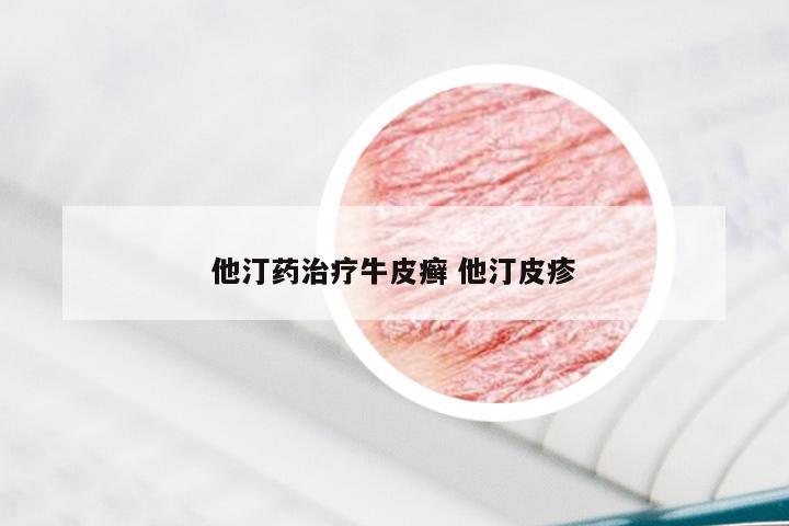 他汀药治疗牛皮癣 他汀皮疹