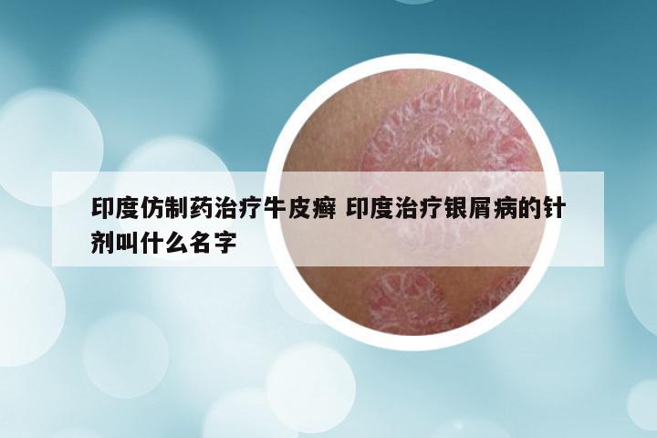 印度仿制药治疗牛皮癣 印度治疗银屑病的针剂叫什么名字