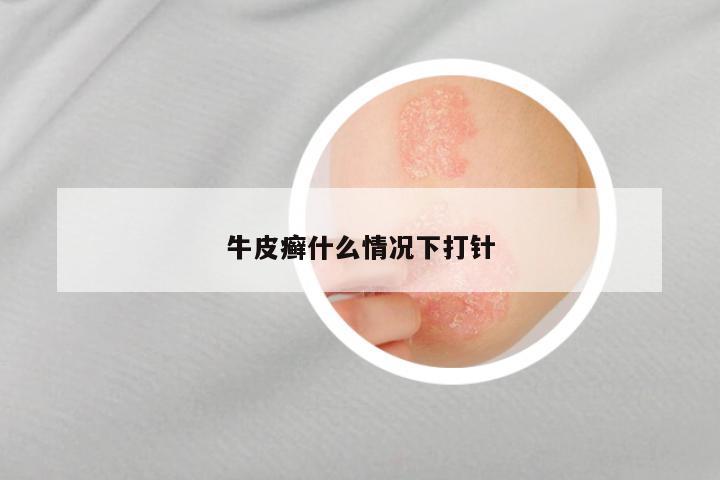 牛皮癣什么情况下打针