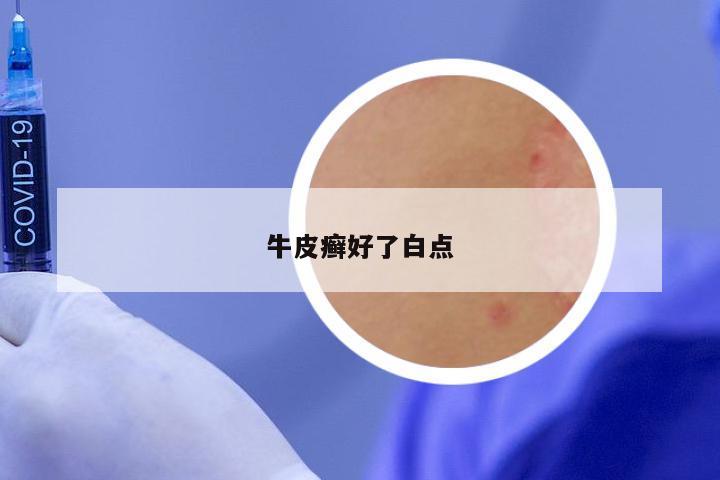 牛皮癣好了白点
