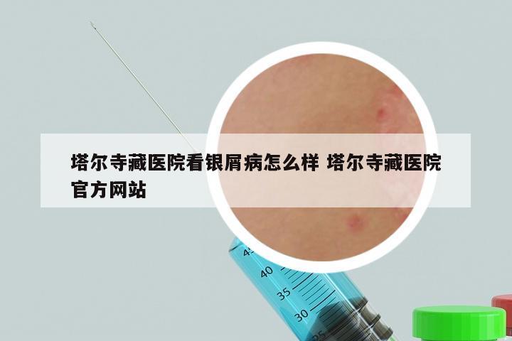 塔尔寺藏医院看银屑病怎么样 塔尔寺藏医院官方网站