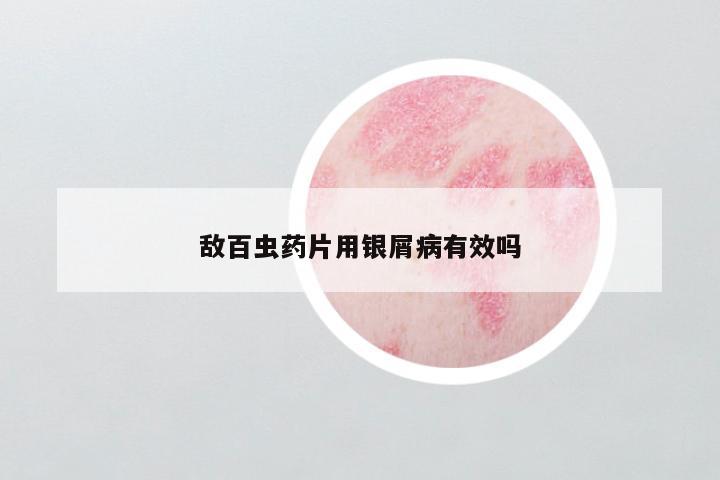 敌百虫药片用银屑病有效吗