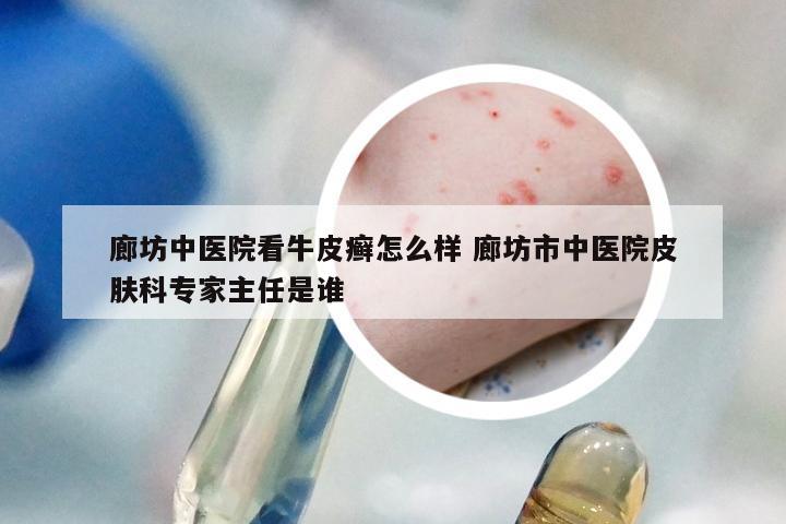 廊坊中医院看牛皮癣怎么样 廊坊市中医院皮肤科专家主任是谁