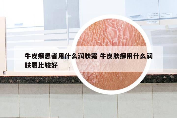 牛皮癣患者用什么润肤霜 牛皮肤癣用什么润肤霜比较好