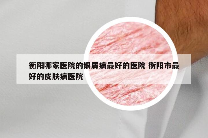 衡阳哪家医院的银屑病最好的医院 衡阳市最好的皮肤病医院