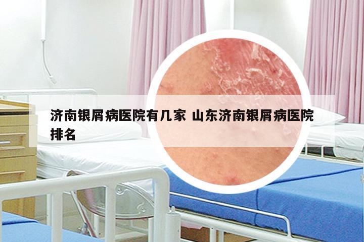 济南银屑病医院有几家 山东济南银屑病医院排名