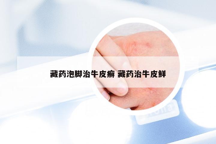 藏药泡脚治牛皮癣 藏药治牛皮鲜