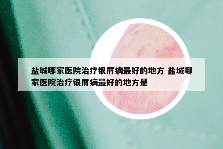 盐城哪家医院治疗银屑病最好的地方 盐城哪家医院治疗银屑病最好的地方是