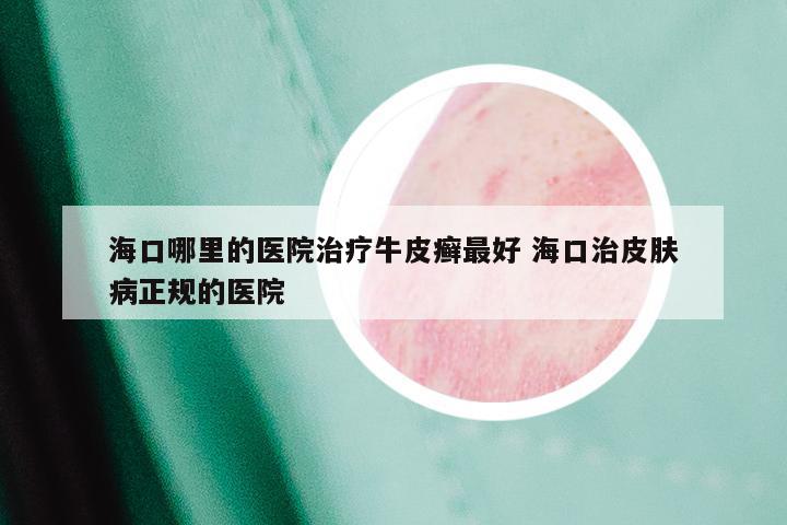 海口哪里的医院治疗牛皮癣最好 海口治皮肤病正规的医院