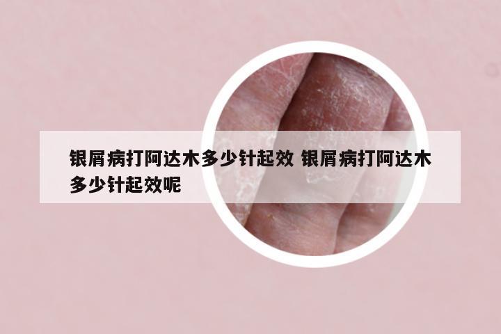 银屑病打阿达木多少针起效 银屑病打阿达木多少针起效呢