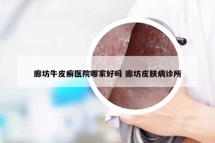 廊坊牛皮癣医院哪家好吗 廊坊皮肤病诊所