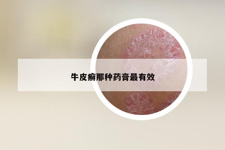 牛皮癣那种药膏最有效