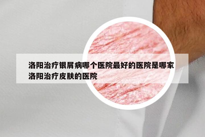 洛阳治疗银屑病哪个医院最好的医院是哪家 洛阳治疗皮肤的医院