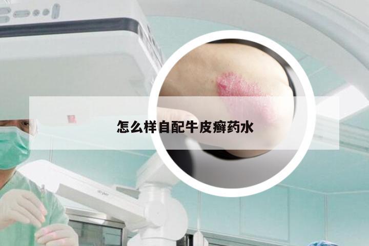 怎么样自配牛皮癣药水