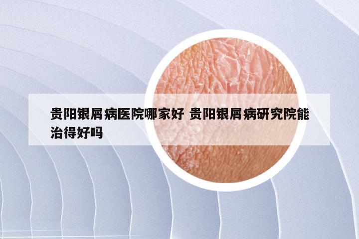 贵阳银屑病医院哪家好 贵阳银屑病研究院能治得好吗