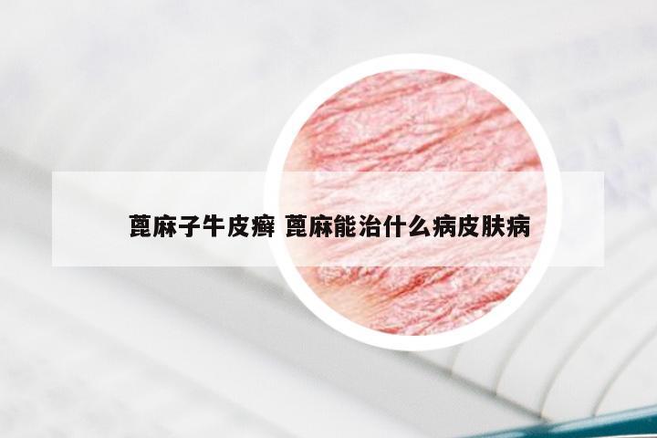 蓖麻子牛皮癣 蓖麻能治什么病皮肤病