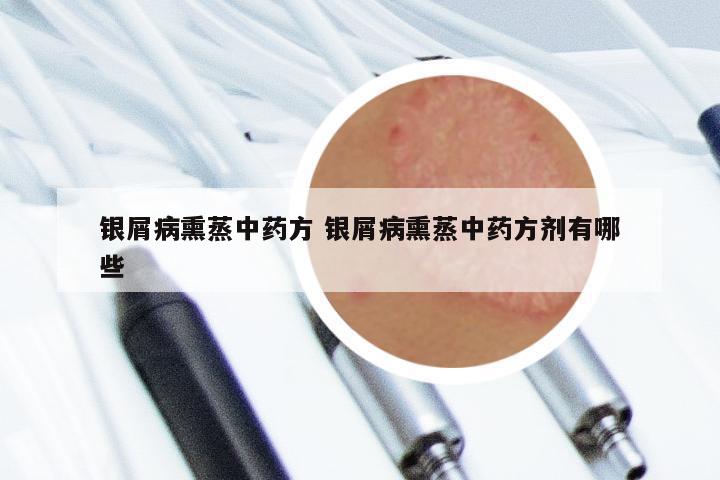 银屑病熏蒸中药方 银屑病熏蒸中药方剂有哪些
