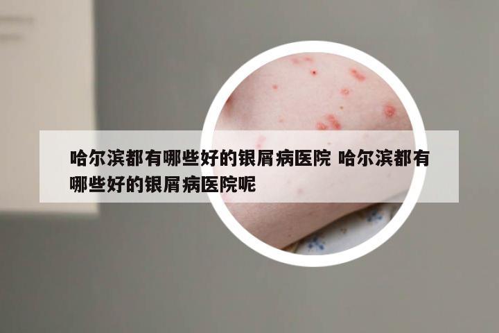 哈尔滨都有哪些好的银屑病医院 哈尔滨都有哪些好的银屑病医院呢