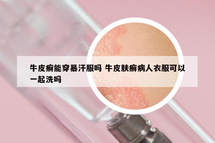 牛皮癣能穿暴汗服吗 牛皮肤癣病人衣服可以一起洗吗