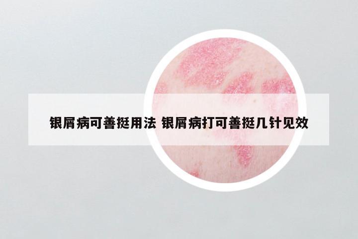 银屑病可善挺用法 银屑病打可善挺几针见效