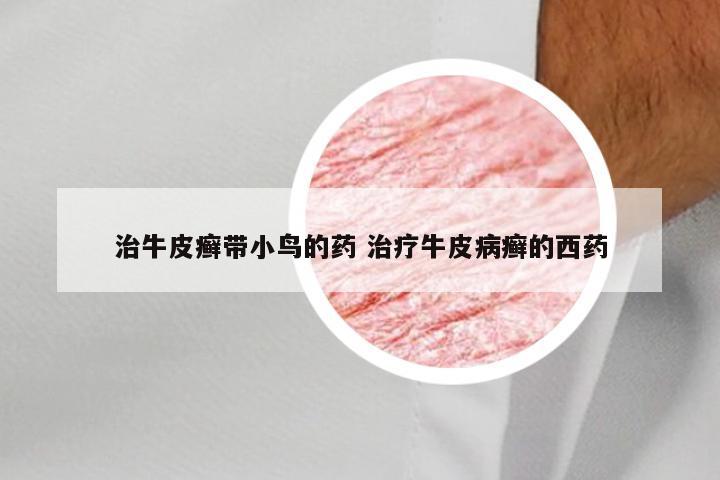 治牛皮癣带小鸟的药 治疗牛皮病癣的西药