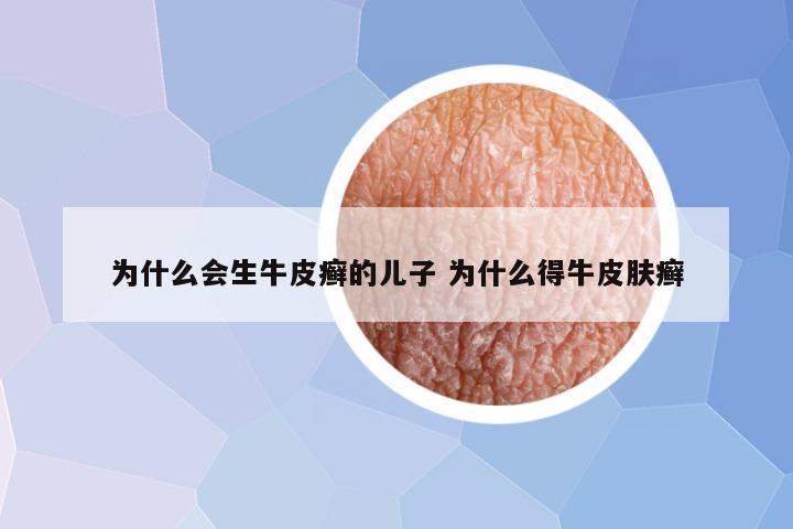 为什么会生牛皮癣的儿子 为什么得牛皮肤癣