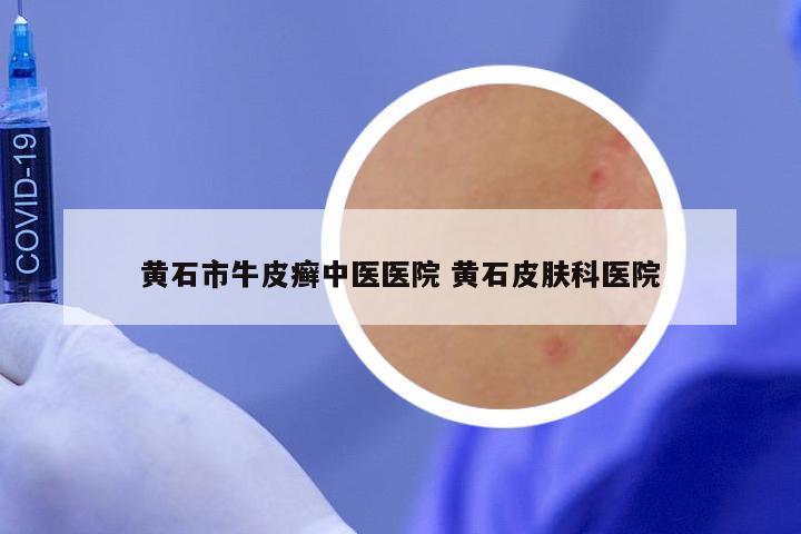 黄石市牛皮癣中医医院 黄石皮肤科医院