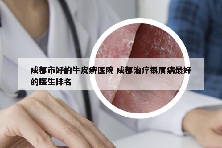 成都市好的牛皮癣医院 成都治疗银屑病最好的医生排名
