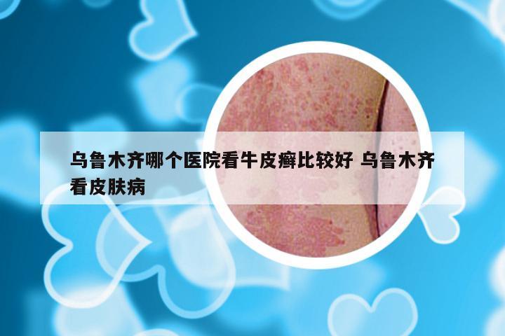 乌鲁木齐哪个医院看牛皮癣比较好 乌鲁木齐看皮肤病
