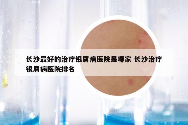 长沙最好的治疗银屑病医院是哪家 长沙治疗银屑病医院排名