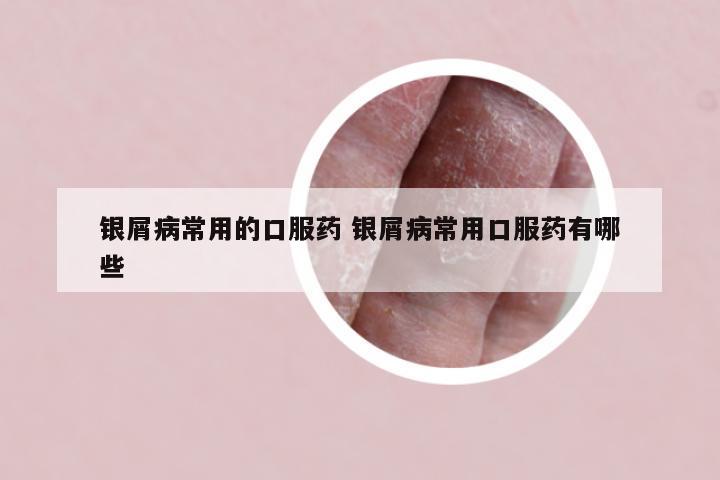 银屑病常用的口服药 银屑病常用口服药有哪些