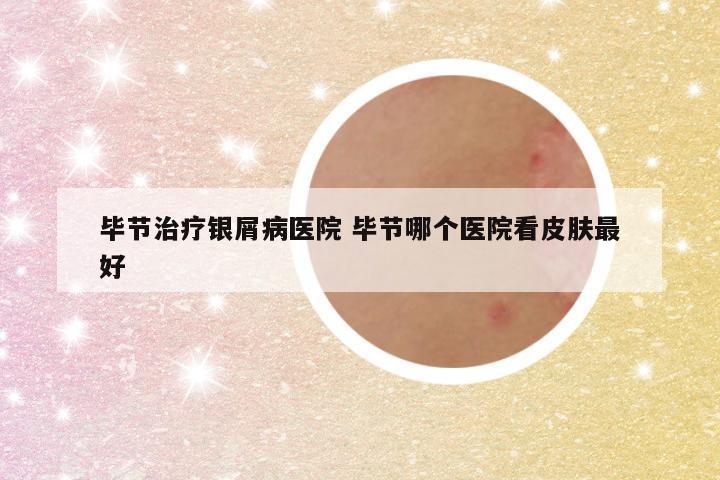 毕节治疗银屑病医院 毕节哪个医院看皮肤最好