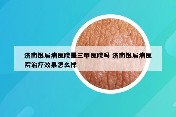 济南银屑病医院是三甲医院吗 济南银屑病医院治疗效果怎么样